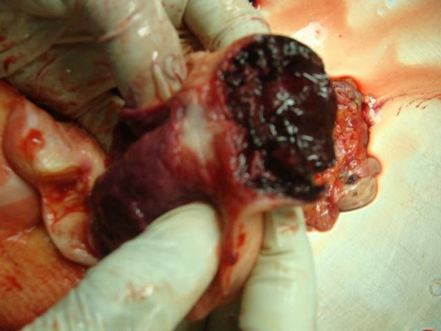 repture of ectopic pregnancy